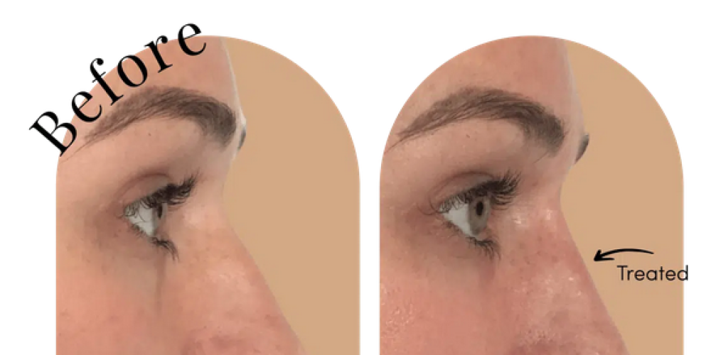 Issues to consider Prior to, During, and Following a Nose area Work